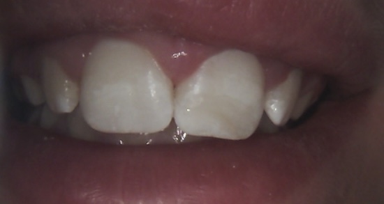 Tooth bonding after