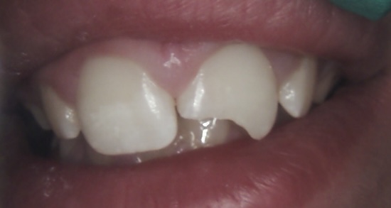 Tooth bonding before