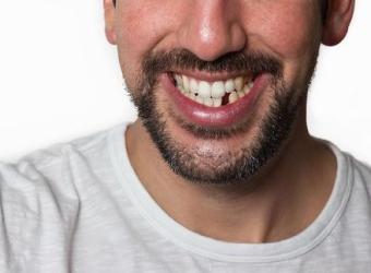 Top 5 Reasons Why You Should Replace a Missing Tooth